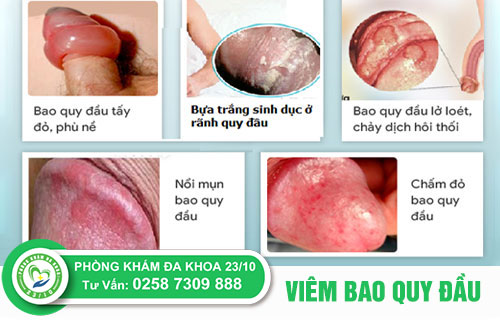 Viêm bao quy đầu gây nổi mụn trắng rãnh quy đầu