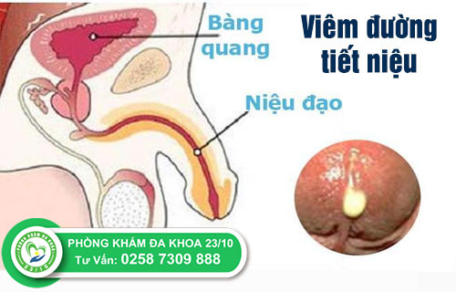 Nguyên gây viêm đường tiết niệu là gì?