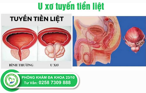 Tuyến tiền liệt bị u xơ dễ dẫn đến tắc nghẽn đường tiểu co nhung benh ly nam khoa nao