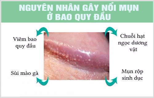 Nguyên nhân nổi mụn trắng ở rãnh bao quy đầu là gì?
